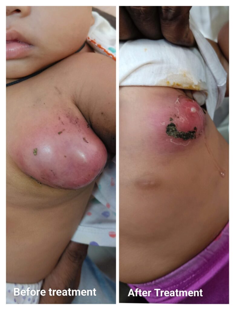 Cystic Lymphangioma cured in bareilly