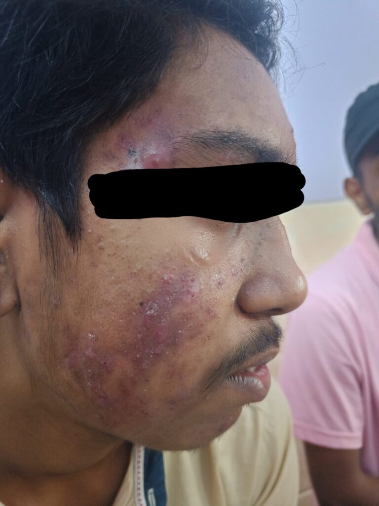 acne treatment in bareilly