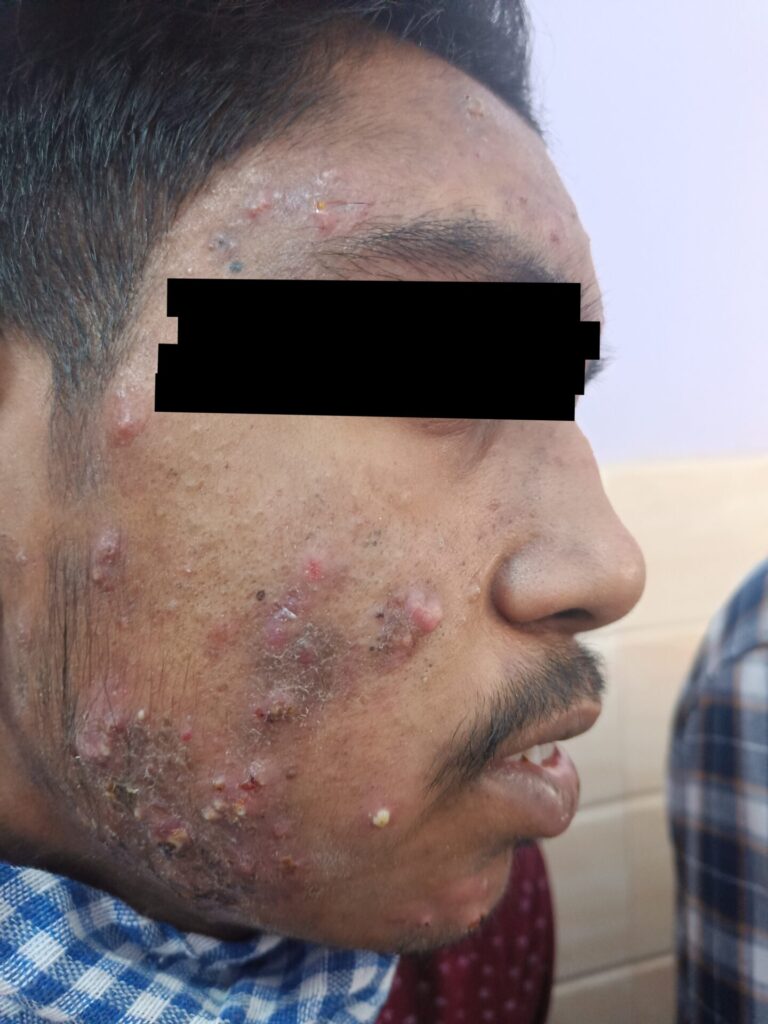 acne treatment in bareilly